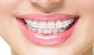 ceramic_braces